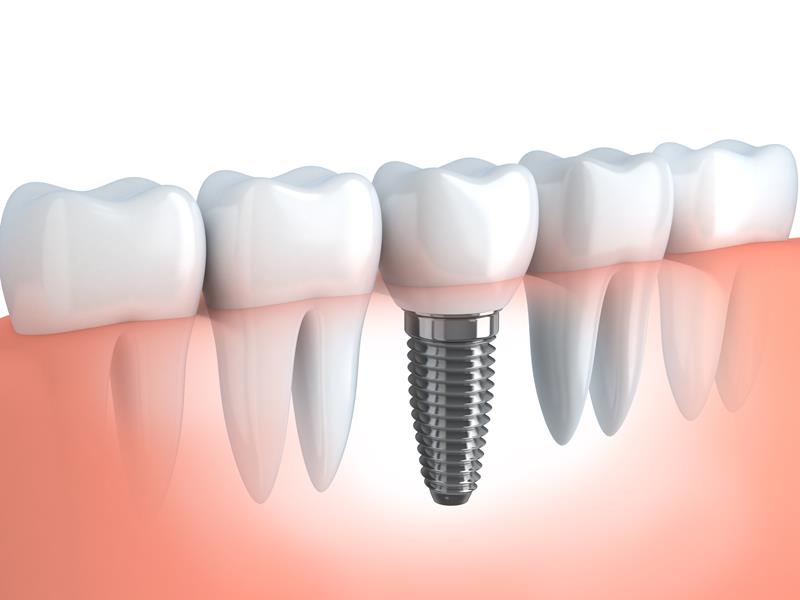 dental-implant